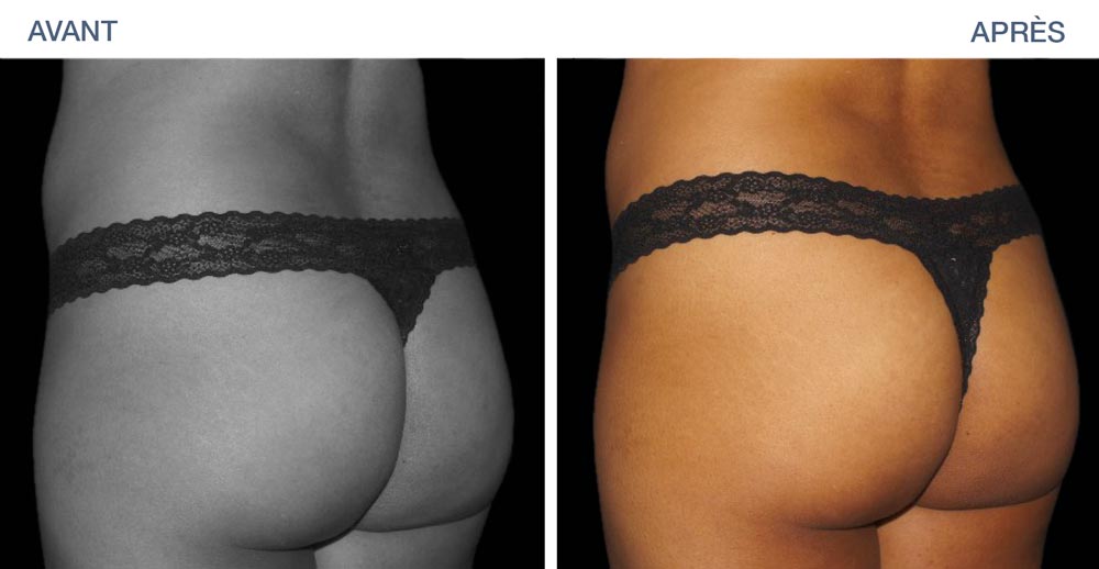 Augmentation le volume des fesses avec EMSculpt