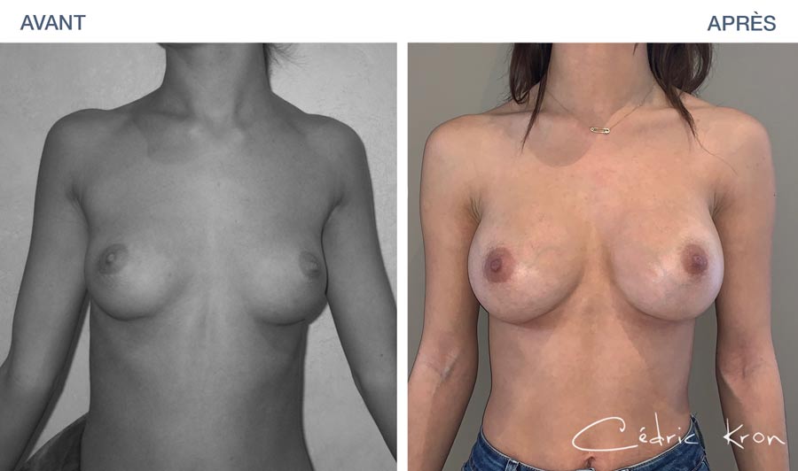 Photos Avant - apres d'une augmentation mammaire par protheses réalisée par le Dr Cédric Kron