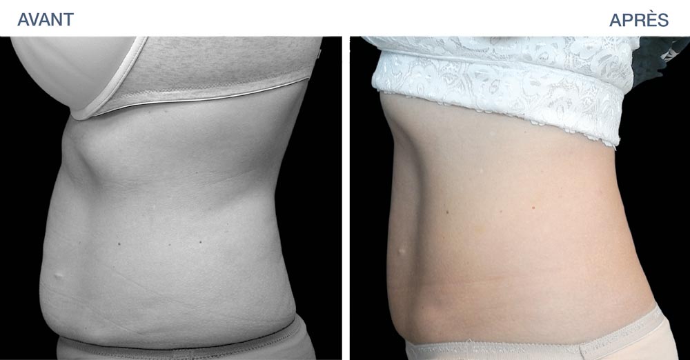 Result of a treatment of the abdominal belt with EMSculpt