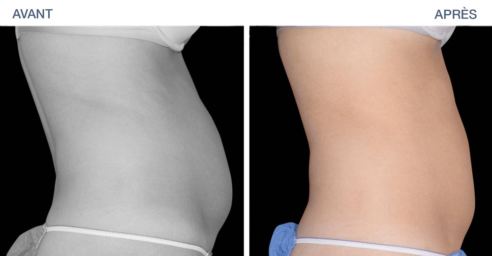 Avant - apres EMSculpt : amincissement de la ceinture abdominale