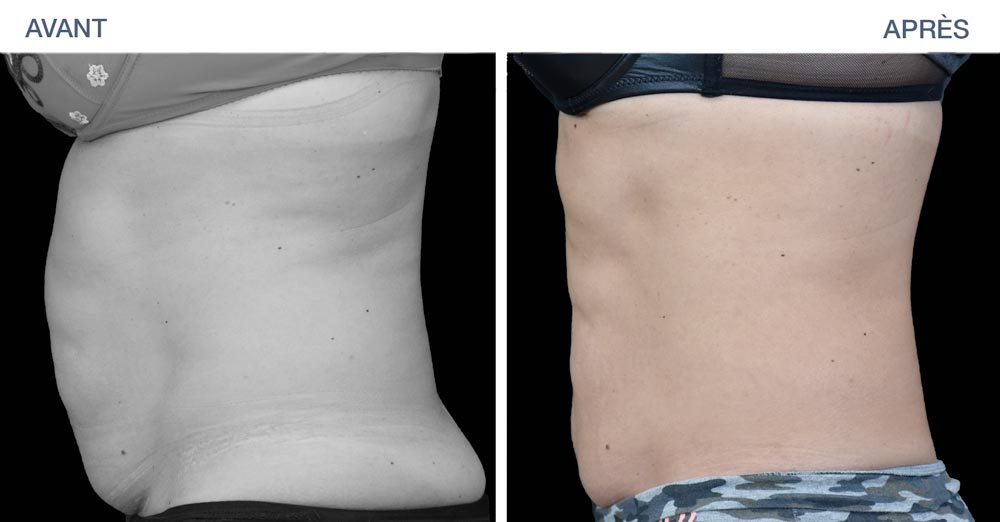 Before - After : Sculpt and tone the abdominals with EMSculpt