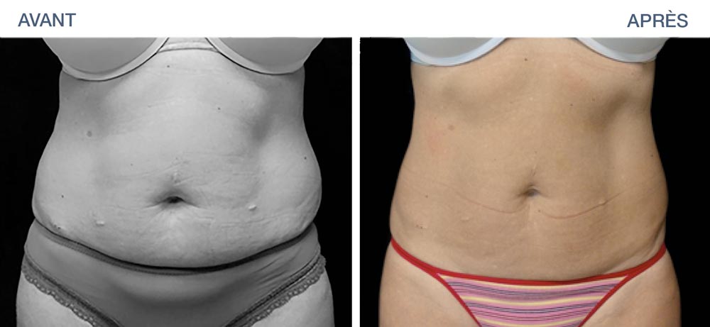 Build muscle in the abdominal belt with EMSculpt sessions in Paris