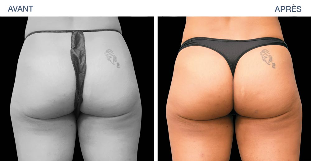 Remove fat in the hips and thighs area with EMSculpt