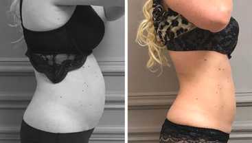 Before & After: Cryolipolyse with Coolsculpting
