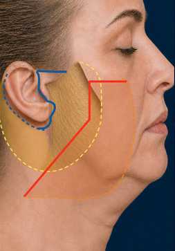 Diagram of an LVPA-type deep plane facelift: Deep plane undermining of the SMAS