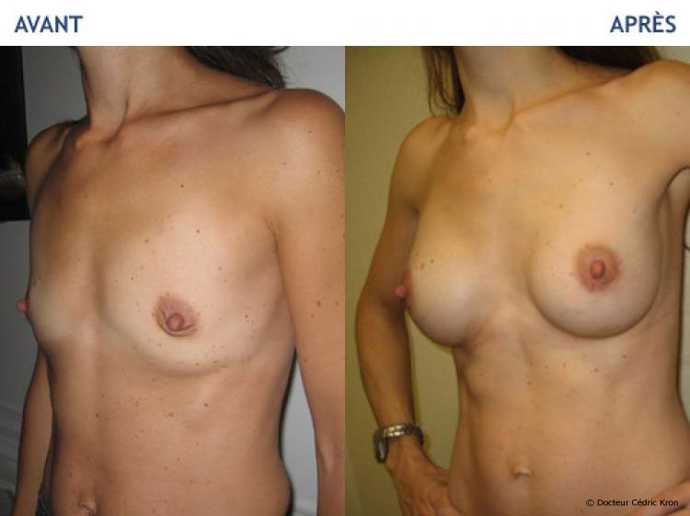 Before - After breast augmentation using implants