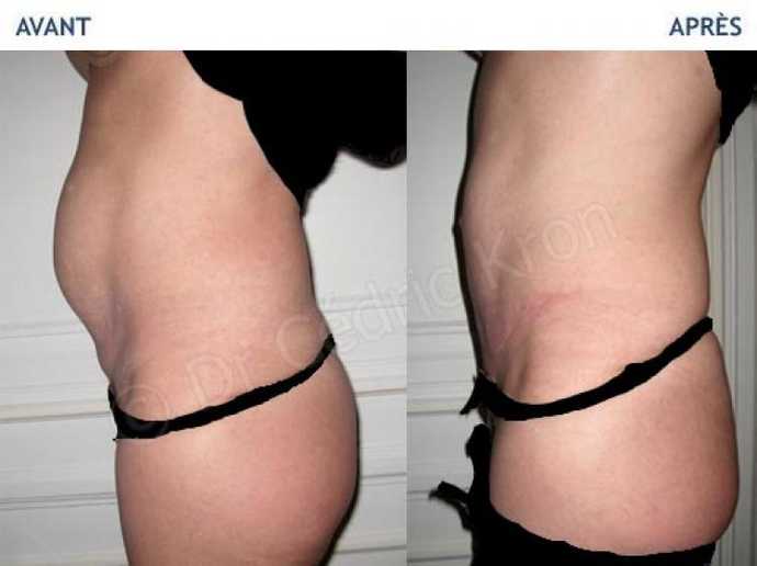 Result of a tummy tuck in before and after photo