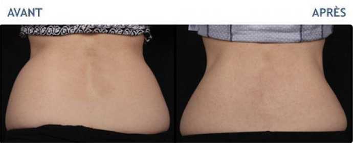 Before & After pictures of Cryolipolyse with Coolsculpting treatment