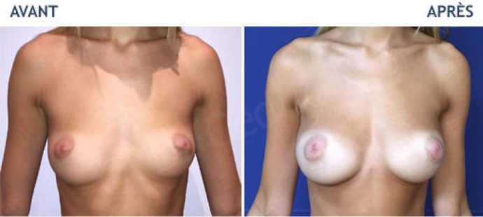 Before - After breast augmentation using implants