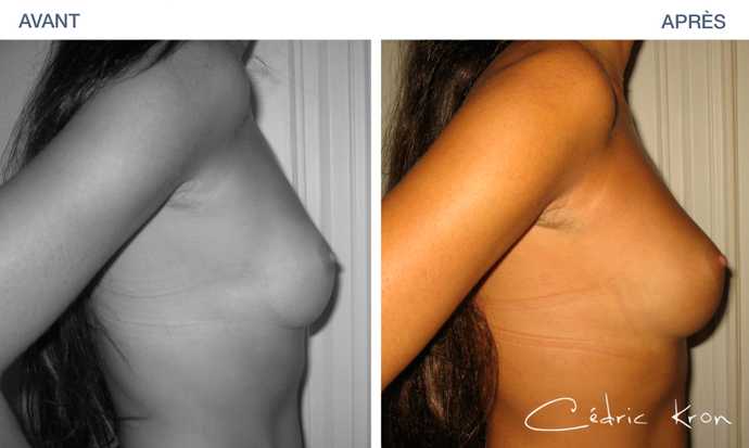 Photos avant - après d'une lipostructure des seins