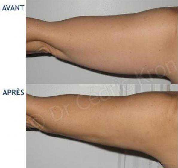 Before and after arm liposuction procedures