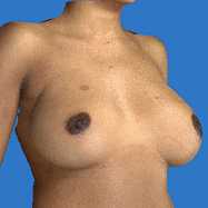 Simulation 3D d'augmentation mammaire