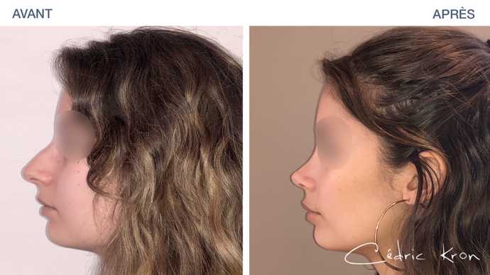 Before - After: Profile view after a rhinoplasty procedure