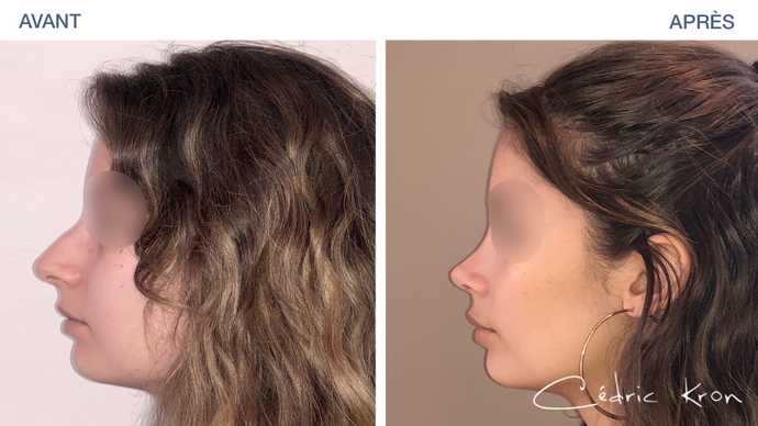 Vue de profil du résultat d'une rhinoplastie en photo avant - après