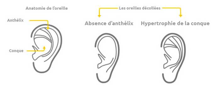 Anatomie des oreilles décollées
