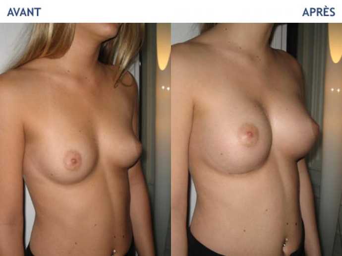 Before - After breast augmentation using implants