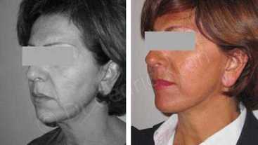 Before & After: Facelift LVPA