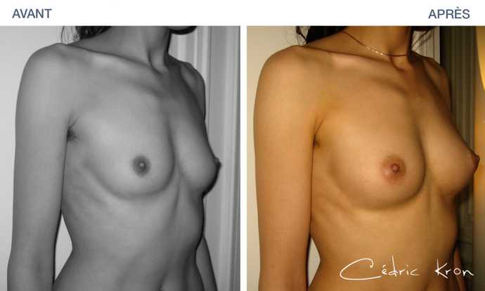Result of a lipofilling cosmetic surgery in before-and-after pictures