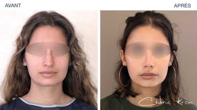 Result obtained after a rhinoplasty procedure on a 20-year-old woman