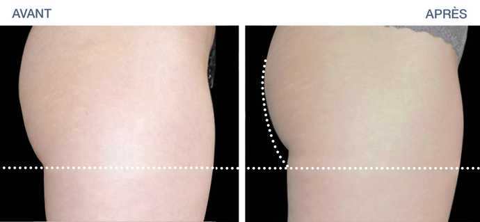 Before-After: Toning of buttocks by EMSculpt
