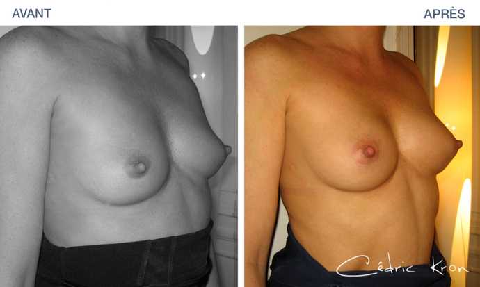 Lipofilling des seins avant - après