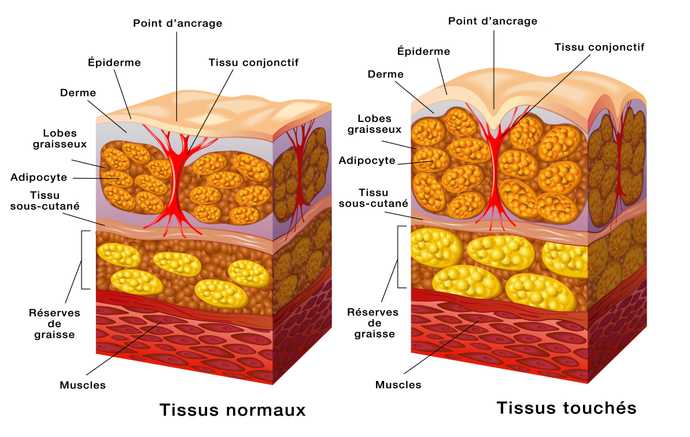 Formation de la cellulite