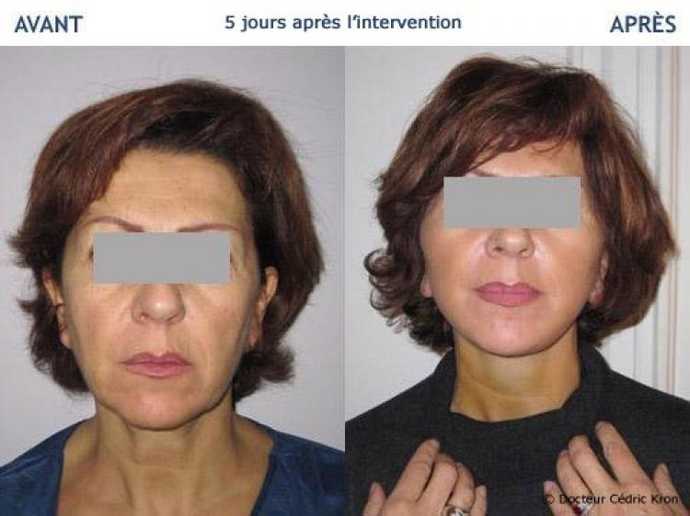 Avant - Après Lifting cervico-facial