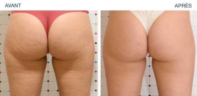 Résultat avant - après d'un traitement pour éliminer la cellulite