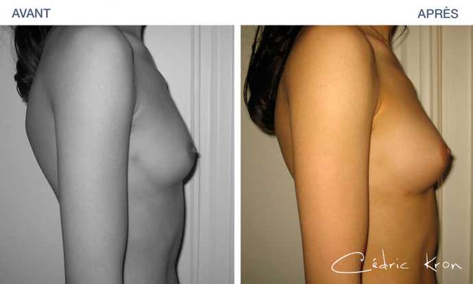 Breast augmentation using fat transplantation in before and after picture