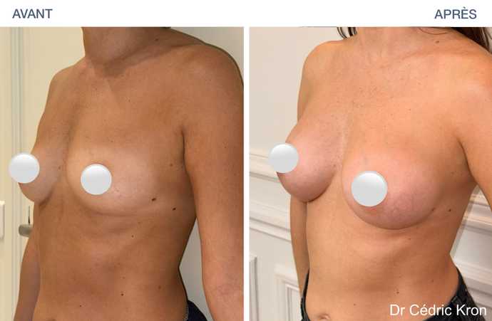 Avant - Après : Augmentation mammaire avec Motiva Preservé (femme de 39 ans)
