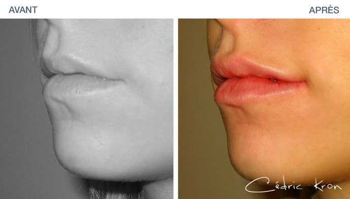 Avant - Après d'une augmentation du volume des lèvres par acide hyaluronique