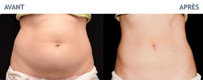 Before & After pictures of Cryolipolyse with Coolsculpting treatment