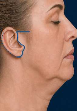 Diagram of an LVPA-type deep plane facelift: Initial state + skin incisions
