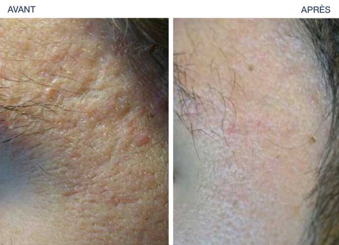 Traitement de séquelles d’acné avec Plexr