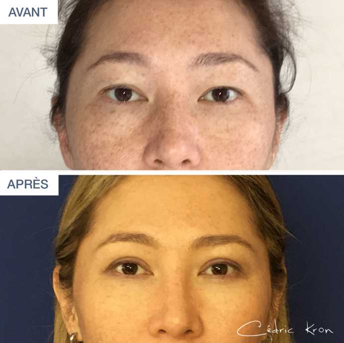 Before and after picture of a asian blepharoplasty