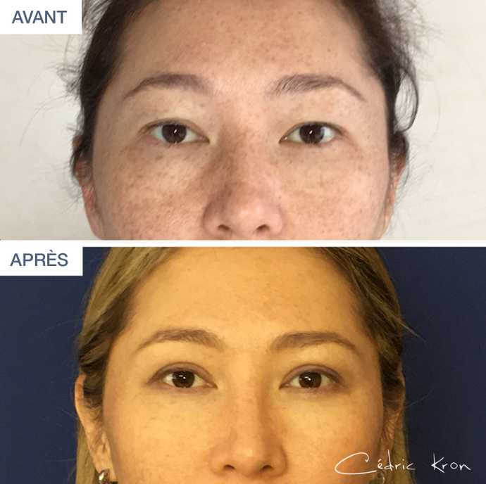 Avant - Après d'une blépharoplastie asiatique