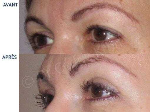 Before and after photo of eyelid surgery