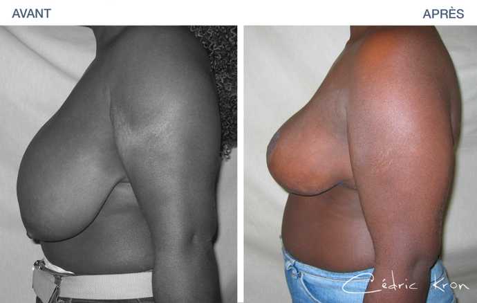 Before & after photo of breast reduction to correct breast hypertrophy