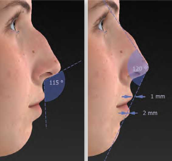 Consultation avant une reprise de rhinoplastie