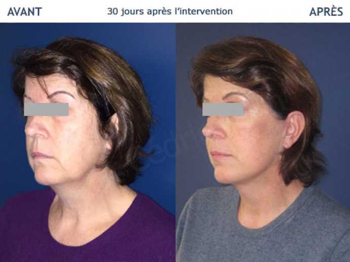 Before - After pictures : result of a facelift procedure in Paris