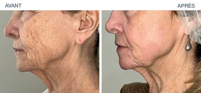 avant apres ultraclear 07