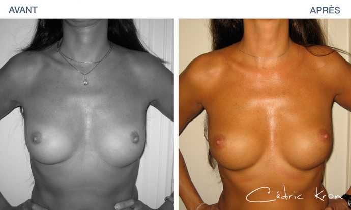 Fat transplatation to increase the volume of breast