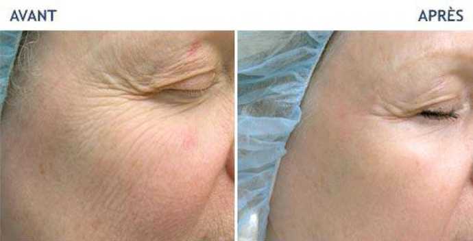 Before and after photos of a laser treatment of the neckline