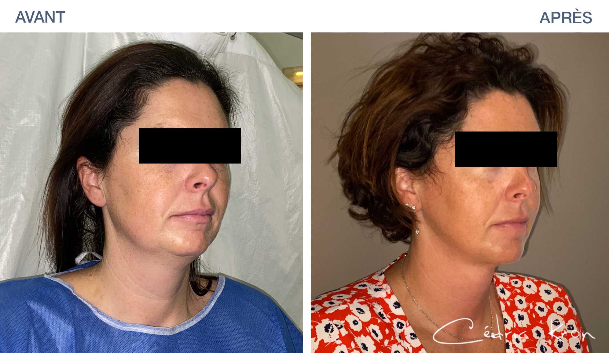 Photos avantaprès Lipoaspiration et Liposuccion Dr Cédric Kron