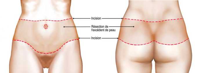 Emplacement des cicatrices induites par un bodylift