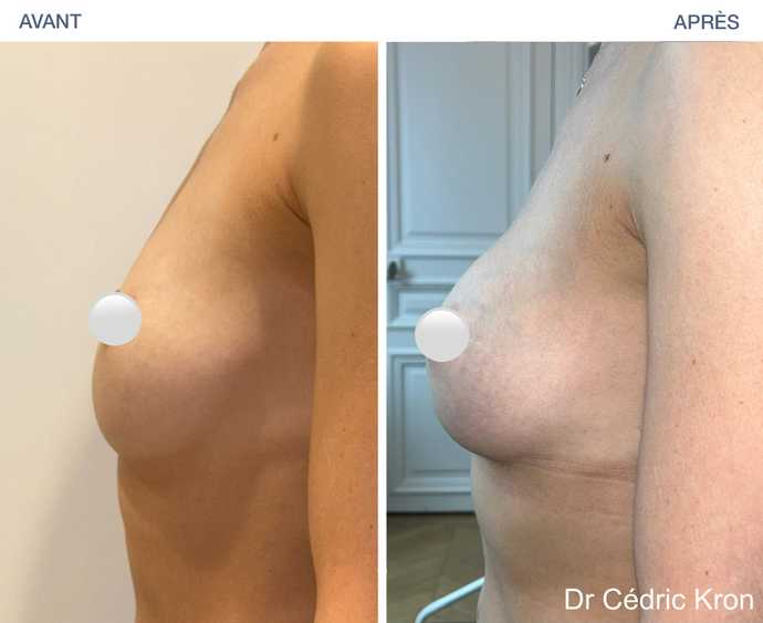 Avant - Après : Augmentation mammaire par prothèse