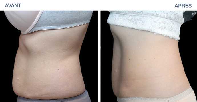 Résultat obtenu par un traitement EMSculpt sur les abdominaux d'une femme à Paris