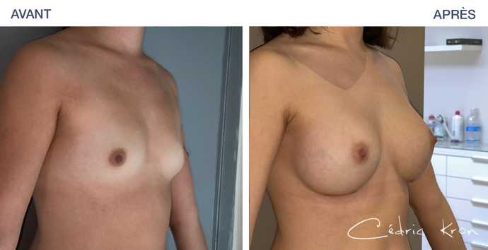 Augmentation mammaire par prothèses en photos avant-après