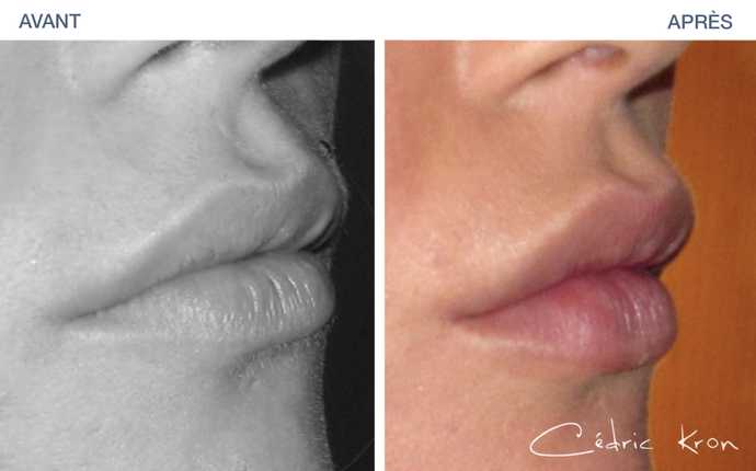 Lipostructure des lèvres avant - après
