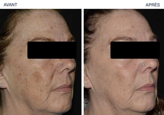 Avant-Après : traitement du mélasma avec LaseMD Ultra